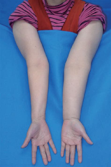 A Patient With Symptomatic Left Upper Extremity Lymphedema Is Shown