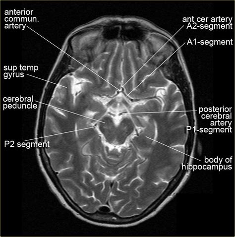 Anatomy Brain Anatomy Radiology Radiology Imaging