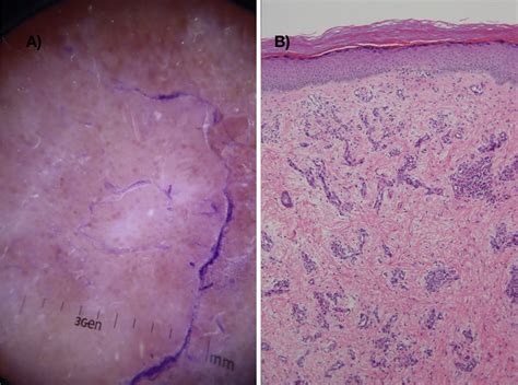 Dermoscopic Vascular Pattern In Porokeratosis Coexistent With Venous