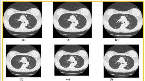 Deep Learning For Lung Cancer Detection And Classification Article New World Artificial