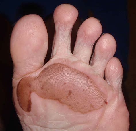 Barefoot Heat Blisters And How To Measure Barefoot Readiness Fun