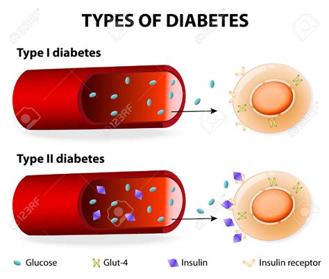Insufficiency of insulin in the organism. Diabete di tipo 1 e 2: ecco la differenza