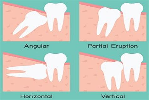 Impacted Wisdom Tooth And Pericoronitis