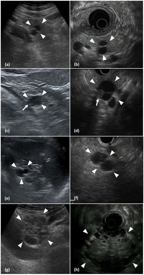 Pancreatic Cystic Lesions Detected On Abdominal Ultrasonography Us