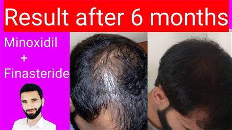 Minoxidil Result After 6 Months Finasteride Result After 6 Months Minoxidil And Finasteride