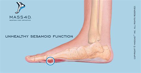 Diagnosis And Treatment Of Sesamoiditis Mass4d® Insoles And Foot