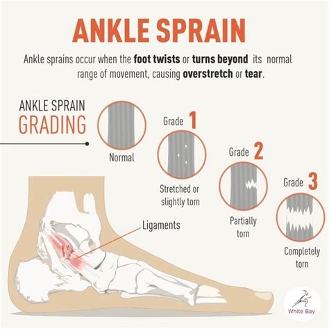 Ankle Sprain Grades