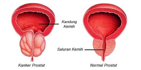 Kanker Prostat Adalah Penyakit Kanker Nomor 2 Pada Pria •