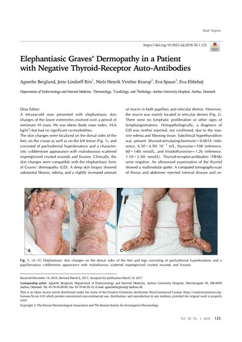 Pdf Elephantiasic Graves Dermopathy In A Patient With Negative