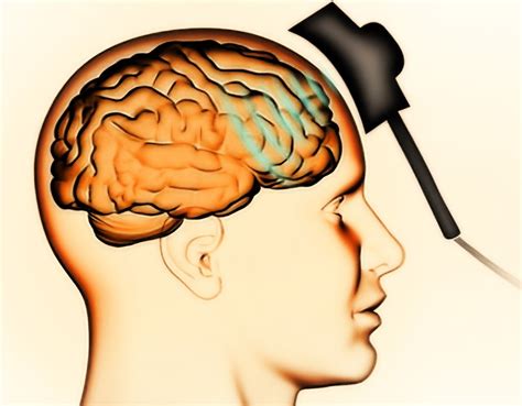 une nouvelle méthode de stimulation magnétique du cerveau promet de traiter les cas de sévère