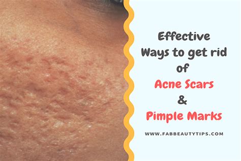Most Effective Ways To Get Rid Of Acne Scars And Pimple Marks