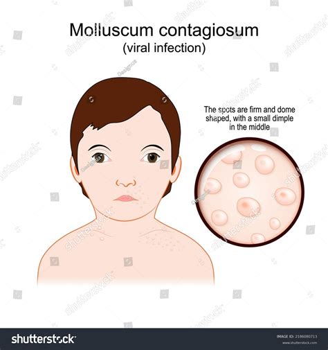 Molluscum Contagiosum Water Warts Viral Infection Stock Vector Royalty