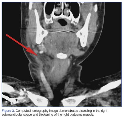 Acute Submandibular Sialadenitis Mdedge Emergency Medicine