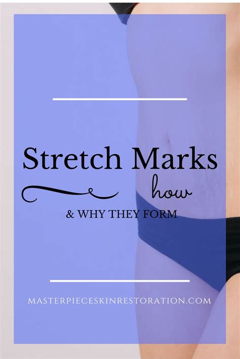 stretch marks how stretch marks form why stretch marks form med spa fort collins anti aging