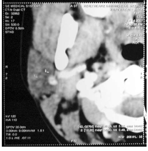 Cect Neck Showing Two Ill Defined Hypodense Lesions Suggestive Of