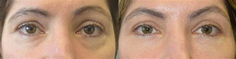 Cosmetic Filler Injection Eyelid Specialists Beverly Hills