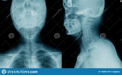 The goal of treatment is to relieve pain, help you maintain your usual activities as much as possible, and prevent. X-ray C-spine, Case Cervical Spondylosis Stock Image ...