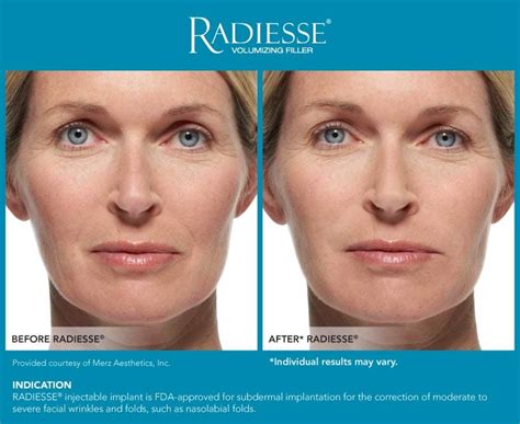Radiesse Cosmetic Treatment Advanced Dermatology Of The Midlands