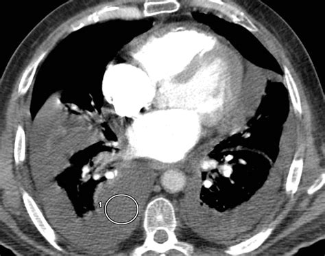 Pleural Effusion Characterization With Ct Attenuation Values And Ct