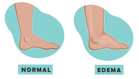 Swollen Ankles Cause 7 Reasons To Be Concerned Newman Feet