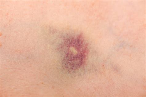 Case Study Abdominal Pain Malaise And A Bruise On The Leg Clinical