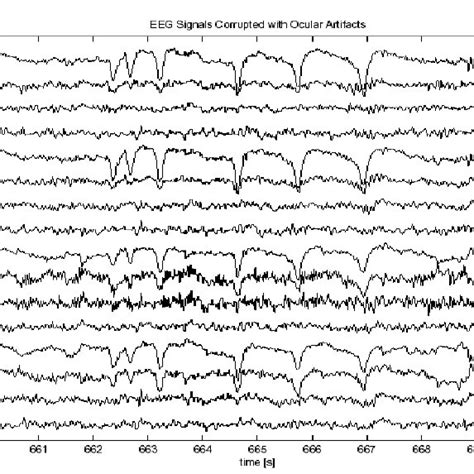 Eeg Recording Corrupted By Ocular Artifacts Download Scientific Diagram