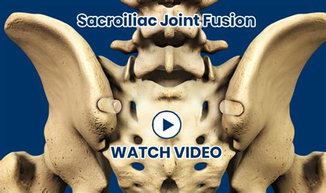 Sacroiliac Joint Fusion Dr Robert Ycaza Bradenton Pain Wellness Center