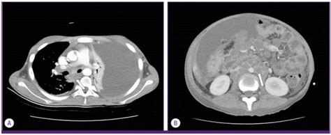 Contrast Enhanced Computed Tomography Ct Scan Images A Chest Ct