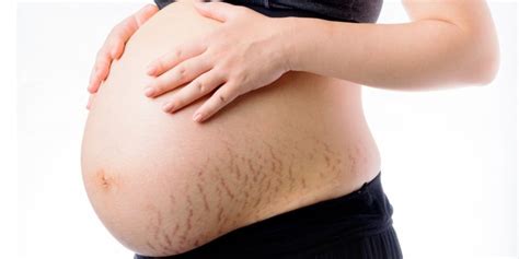 Stretch Marks During Pregnancy Causes And How To Minimise The Lines