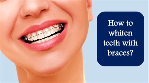 how to whiten teeth while having braces houses and apartments for rent