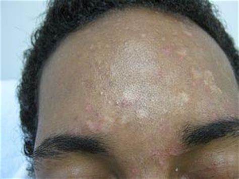 Tinea versicolor is a common fungal infection of the skin. Pityriasis rosea treatment - Get skin relief now | General ...