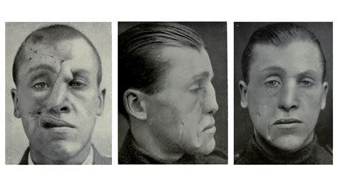Innovative Cosmetic Surgery Restored Wwi Vets Ravaged Faces—and Lives