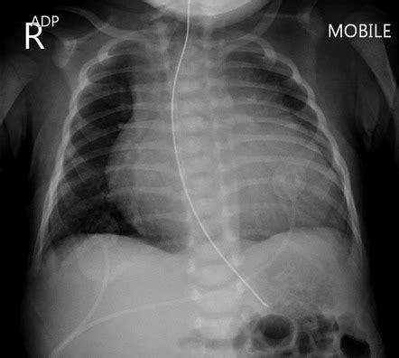 Pulmonary Artery Atresia Radiology Reference Article Radiopaedia Org