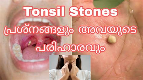 Tonsil Stone Youtube