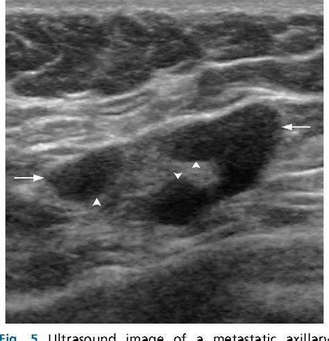 Lymph Node Mapping Ultrasound