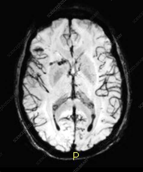 Severe Traumatic Brain Injury Mri Stock Image C0271729 Science