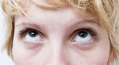 5 ways to say goodbye to dark circles and puffy eyes health news and views skin