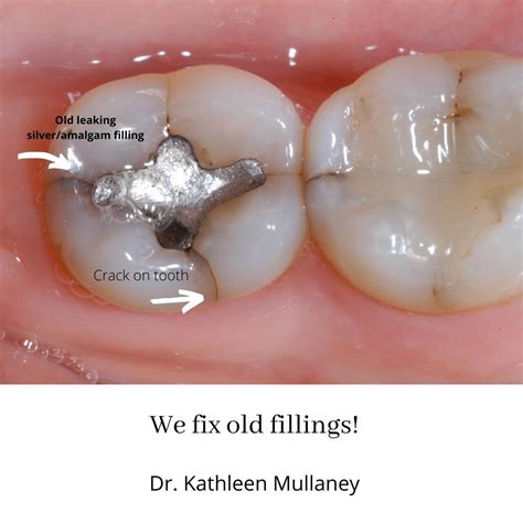 Do You Have Old Silver Fillings Tooth Colored Fillings Dental