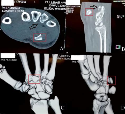 Diagnosis Of A Hamate Hook Fracture With 3d Reconstruction Of Computed