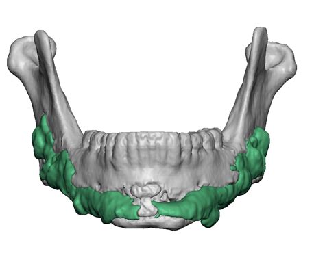 Hydroxyapatite Bone Cement Jaw Augmentation Creates Bone Imprinting