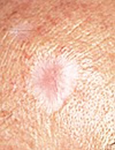 Skin Cancer On Face White Spot