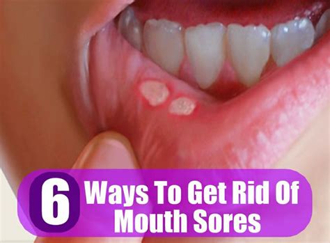 6 Ways To Get Rid Of Mouth Sores Dental Care Pinterest