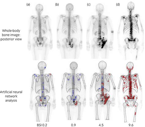 Bone Scan Index A New Biomarker Of Bone Metastasis In Patients With Prostate Cancer Nakajima