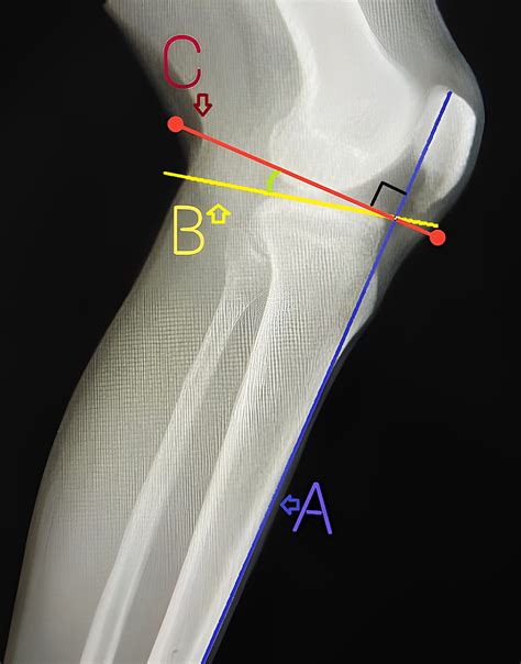 Cureus Anatomical Variations In The Posterior Tibial Slope In The