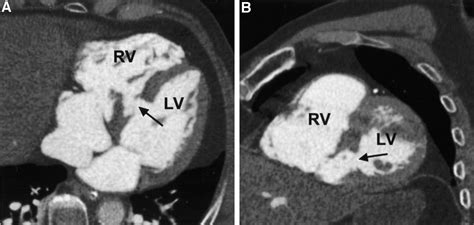 Ventricular Septum Rupture After Myocardial Infarction Demonstrated By