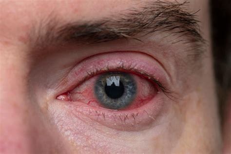 How Quickly Can Pink Eye Spread Benjamin Optical Eye Center