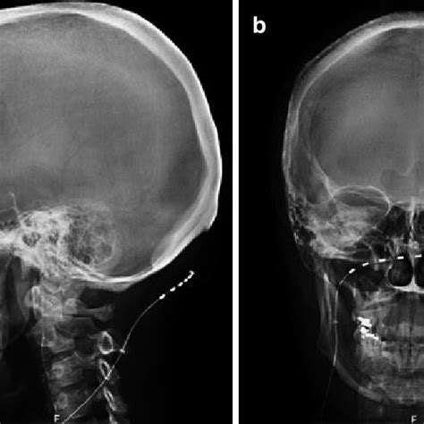 Pdf Representative Clinical Case Occipital Neuralgia