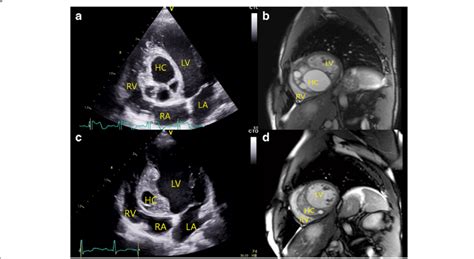 Giant Hydatid Cyst In The Interventricular Septum A 2d Transthoracic