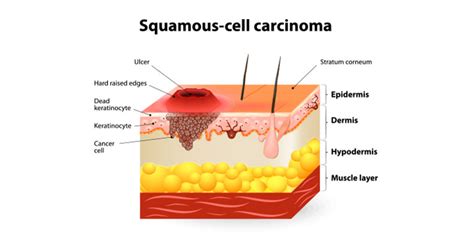 Squamous Cell Carcinoma What You Should Know Columbia Skin Clinic