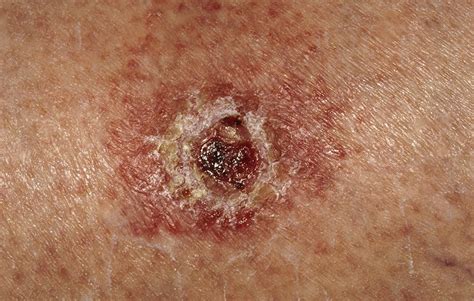 5 Signs Of Skin Cancer Other Than A New Mole Prevention Magazine Scoopnest